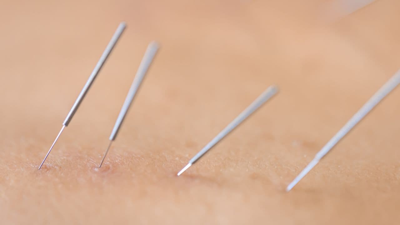 imagem sobre Acupuntura para que serve? Conheça aqui as motivações